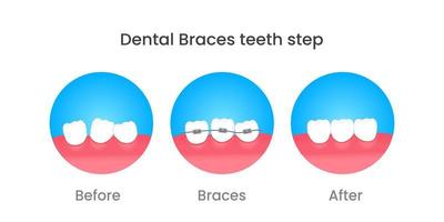 étapes orthodontiques avant et après orthodontie vecteur