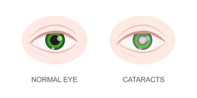 vue rapprochée des yeux sains et de la cataracte. globe oculaire avec lentille normale et trouble. organe de vision humain anatomiquement précis. problèmes visuels liés au vieillissement vecteur