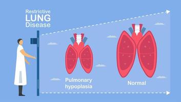 l'hypoplasie pulmonaire est incomplète des poumons. vecteur