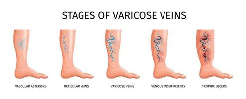 étapes des varices vecteur