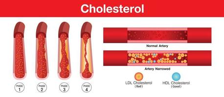 cholestérol dans l'artère, risque pour la santé, conception vectorielle vecteur