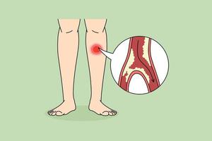 gros plan sur une personne souffrant d'une maladie du tampon ayant un blocage des vaisseaux sanguins dans les jambes. l'homme lutte avec des membres coagulés à cause du rétrécissement ou du blocage des veines. concept de soins de santé. illustration vectorielle. vecteur