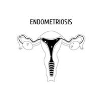 contour des organes génitaux féminins. endométriose vecteur