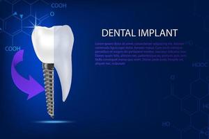 conditions dentaires saines, implant dentaire sur un fond abstrait de technologie bleue. vecteur