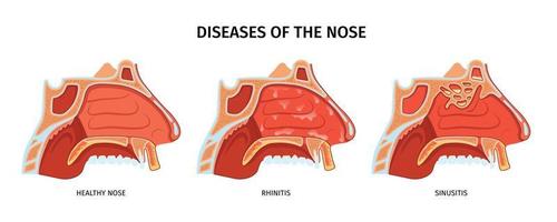 affiche sur les maladies du nez vecteur