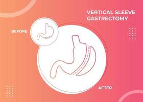 gastrectomie à manchon laparoscopique, gastrectomie verticale, chirurgie de perte de poids illustration vectorielle de la chirurgie de réduction de l'estomac vecteur