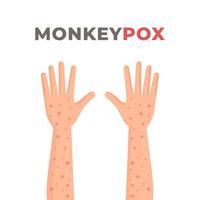 symptômes de la variole du singe. illustration vectorielle d'éruption cutanée sur les mains. épidémie de monkeypox en afrique et en espagne. infection. vecteur