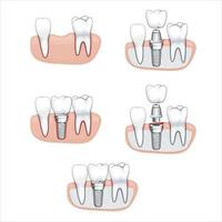 illustration de couronne dentaire, dents saines, illustration vectorielle de dentiste, soins bucco-dentaires vecteur