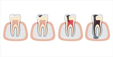 illustration de dent endommagée, dents endommagées, illustration vectorielle de dentiste, soins bucco-dentaires vecteur