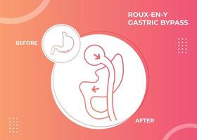 roux en y pontage gastrique rny chirurgie de perte de poids icône d'illustration vectorielle vecteur