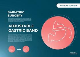 illustration d'un anneau gastrique réglable concevoir un vecteur de chirurgie de perte de poids