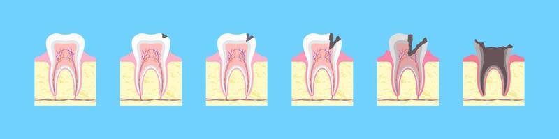 processus de destruction carieuse de la dent. formation osseuse saine avec fissure noire et inflammation progressive. carie de l'émail avec infection dentaire et perte complète du vecteur