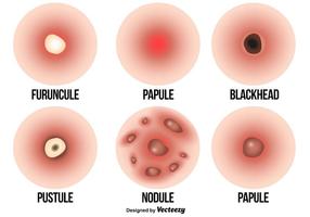 Vector Set Of The Types of Pimples