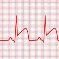 représente des ecgs pour l'infarctus du myocarde. signe de crise cardiaque. symbole de thrombose de l'artère coronaire. style plat. vecteur