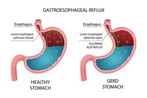 infographie de l'estomac et du RGO en bonne santé vecteur