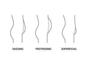 types ventres du corps humain, gros ventre avec surpoids, vue latérale en ligne. Ventre affaissé, saillant et superficiel. perte de poids, réduction du volume du ventre, chirurgie plastique opération. illustration vectorielle vecteur