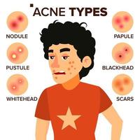 vecteur de types d'acné. garçon avec de l'acné. boutons, rides, peau sèche, points noirs. illustration de personnage de dessin animé plat isolé