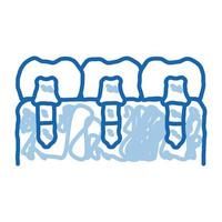 dents dentaires implants biomatériau doodle icône illustration dessinée à la main vecteur