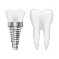 illustration de conception de vecteur implant dentaire isolé sur fond blanc