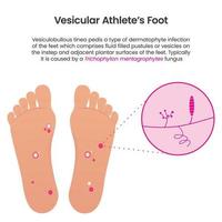 infographie vectorielle éducative du pied d'athlète vésiculaire vecteur