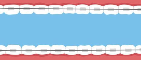 bannière d'accolades de dents. problème d'orthodontie, sourire avec brackets, retenue. illustration de vecteur plat isolé