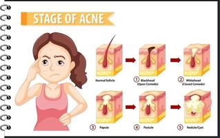 étapes de l'anatomie de l'acné de la peau avec une femme faisant pose stressante vecteur