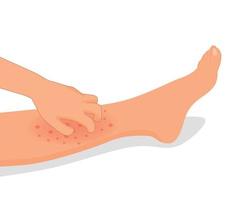 femme main scratch sa qui démange jambe avec téméraire sec peau car de allergique réaction vecteur