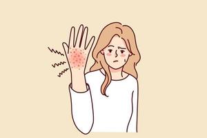 malheureux femme souffrir de rougeur sur main. indisposé fille lutte avec psoriasis ou saisonnier allergie. soins de santé concept. vecteur illustration.