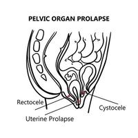 pelvien organe prolapsus monochrome éducation schème vecteur ensemble