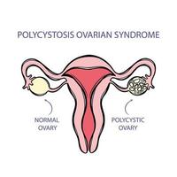 polycystose ovaire syndrome femelle reproducteur système vecteur
