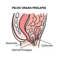 pelvien organe prolapsus médical éducation schème vecteur ensemble