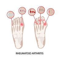 rhumatoïde maladie jambe arthrite médicament éducation schème vecteur