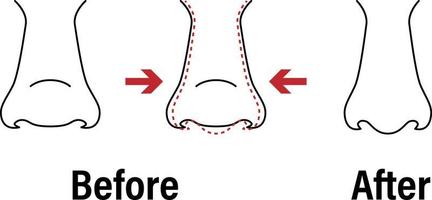 vecteur illustration. de face vue de une large Humain nez avant, après esthétique Plastique chirurgie - rhinoplastie nez emploi . proche en haut voir. pour publicité, médical et beauté éditions. eps dix