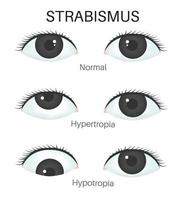 les types de strabisme - hypertopie et hypotopie vecteur