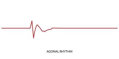 ecg battement de coeur doubler. électrocardiogramme vecteur illustration. agonique rythme