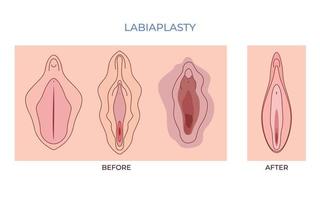 labiaplastie. vaginoplastie. femmes génital de mineur vulvaire lèvres ample lèvres beauté chirurgie à serrer vecteur