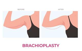 brachioplastie ou plus haut bras ascenseur Plastique chirurgie dans femme. de face vue vecteur