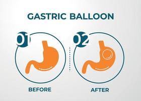 endoscopie gastrique ballon gastrique à l'intérieur d'un estomac chirurgie de perte de poids illustration vectorielle obésité vecteur
