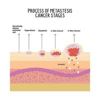 processus de métastases cancer étapes illustration sur blanc Contexte. vecteur