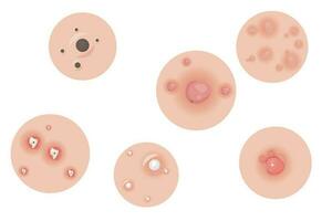 vecteur collection de les types de boutons à l'intérieur le peau faciale infections, boutons et peau inflammation. soins de la peau, visage acné éclater. dermatologie épiderme