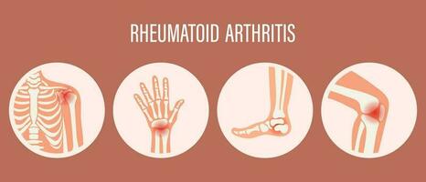 rhumatoïde arthrite Icônes. le genou articulation, épaule articulation, poignet articulation, pied articulation. les types de arthrite. médical concept. vecteur