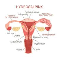 hydrosalpinx. le Fallope tubes sont bloqué et rempli avec séreux ou clair fluide. gynécologie. médicament. infographie bannière, vecteur. vecteur