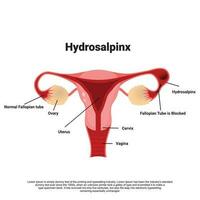 hydrosalpinx diagramme, obstrué follopien tube, infection ou membrane couvrant le Fallope tube cause obstruction vecteur