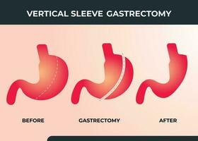 gastrectomie à manchon laparoscopique, gastrectomie verticale, chirurgie de perte de poids illustration vectorielle de la chirurgie de réduction de l'estomac vecteur