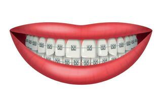 les dents un appareil dentaire réaliste vecteur