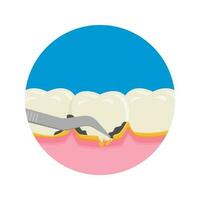 les dents mise à l'échelle, dentaire plaque suppression pour nettoyage et santé vecteur