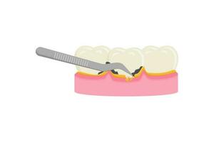 les dents mise à l'échelle, dentaire plaque suppression pour nettoyage et santé vecteur