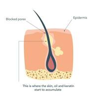 enflammé peau autour le cheveux follicules Profond dans le pores. premier étape de inflammation, où peau, pétrole et kératine avoir accumulé. vecteur illustration