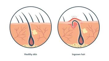 incarné cheveux et Ordinaire cheveux médical schémas en dessous de microscope. incarné cheveux pistes à le rougeur et inflammation, cette associé aussi avec boutons. vecteur illustration