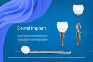 Humain les dents et dentaire implant vecteur illustration.